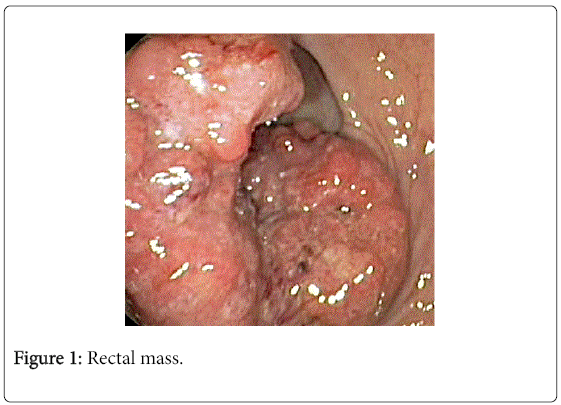 gastrointestinal-digestive-system-Rectal-mass
