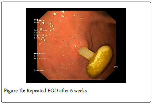 gastrointestinal-digestive-system-Repeated-EGD