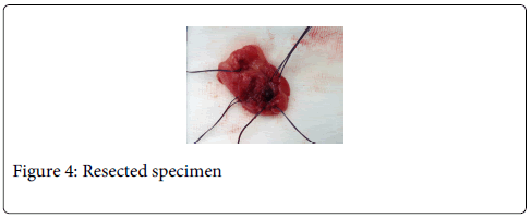 gastrointestinal-digestive-system-Resected-specimen