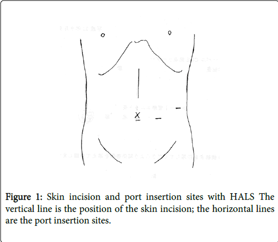 gastrointestinal-digestive-system-Skin-incision