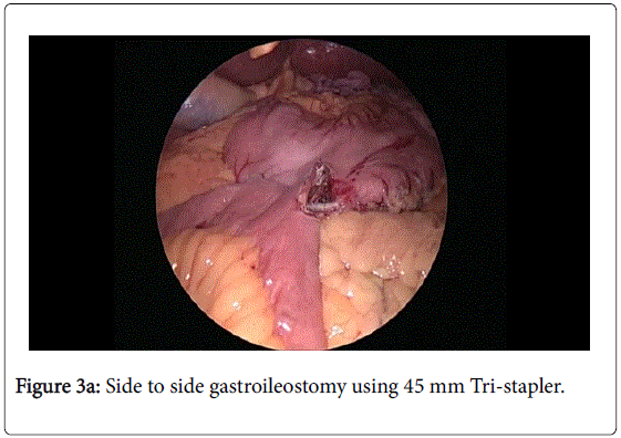 gastrointestinal-digestive-system-Tri-stapler