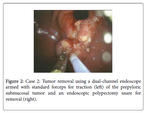 gastrointestinal-digestive-system-Tumor-removal
