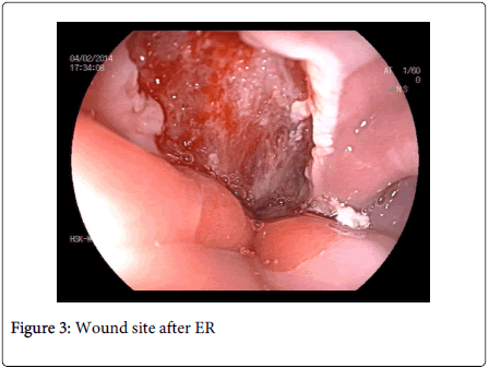 gastrointestinal-digestive-system-Wound-site