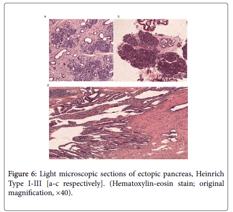 gastrointestinal-digestive-system-ectopic-pancreas