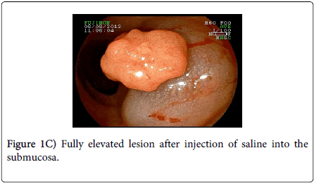 gastrointestinal-digestive-system-elevated-lesion