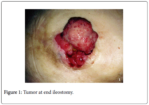 gastrointestinal-digestive-system-end-ileostomy