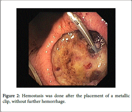 gastrointestinal-digestive-system-further-hemorrhage