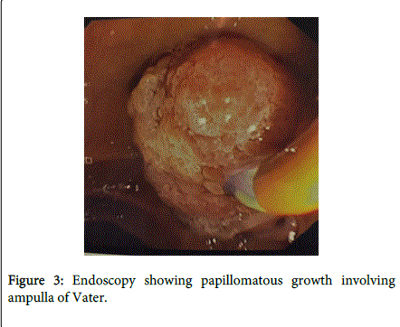 gastrointestinal-digestive-system-growth-involving