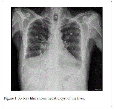 Uncomplicated Hydatid Cysts Of The Liver Clinical Presentation Diagnosis And Treatment Omics International