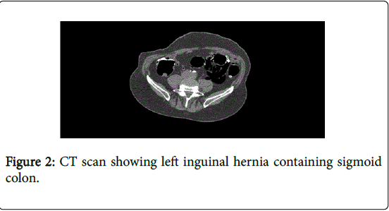 gastrointestinal-digestive-system-inguinal-hernia