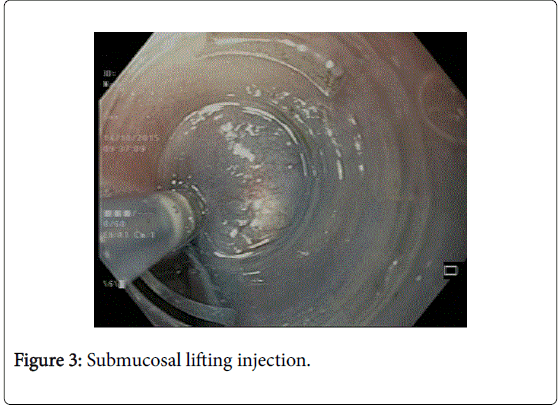 gastrointestinal-digestive-system-lifting-injection