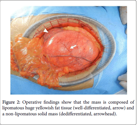 gastrointestinal-digestive-system-lipomatous-huge