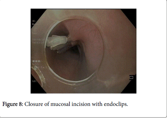 gastrointestinal-digestive-system-mucosal-incision