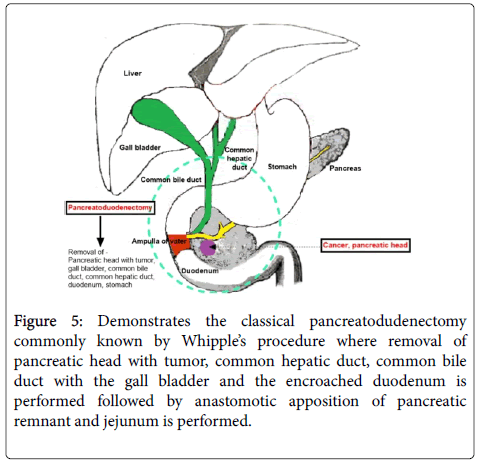 gastrointestinal-digestive-system-pancreatodudenectomy