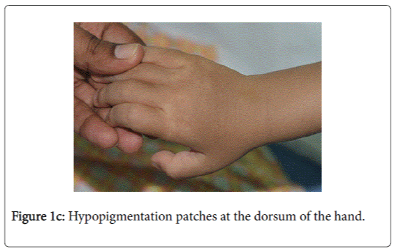 gastrointestinal-digestive-system-patches-dorsum-hand