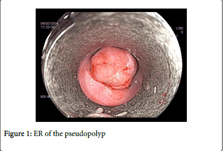 gastrointestinal-digestive-system-pseudopolyp