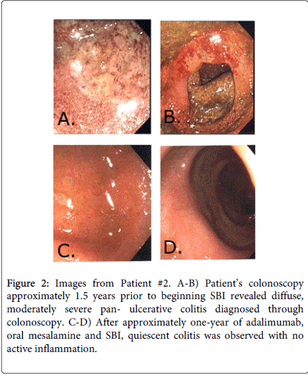 gastrointestinal-digestive-system-quiescent-colitis