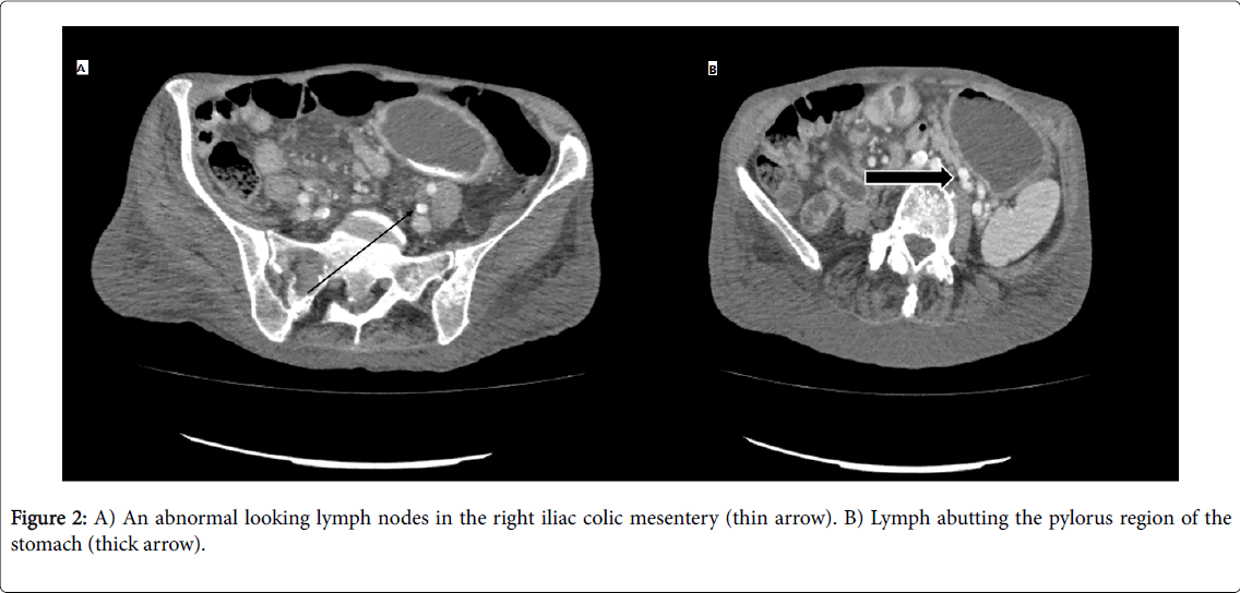 gastrointestinal-digestive-system-right-iliac