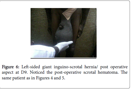 gastrointestinal-digestive-system-scrotal-hematoma