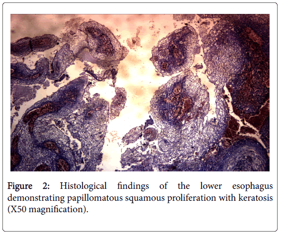 gastrointestinal-digestive-system-squamous-proliferation