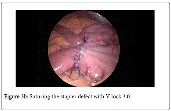 gastrointestinal-digestive-system-stapler-defect