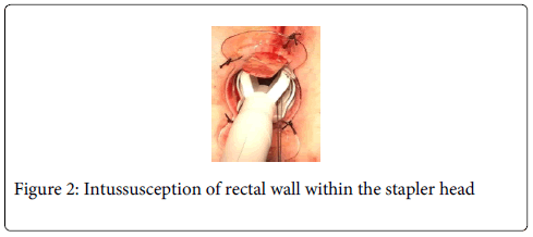 gastrointestinal-digestive-system-stapler-head