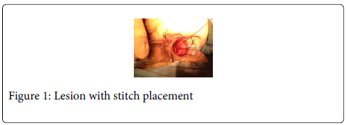 gastrointestinal-digestive-system-stitch-placement