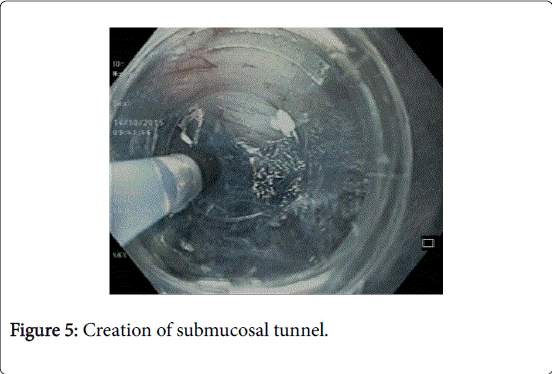gastrointestinal-digestive-system-submucosal-tunnel