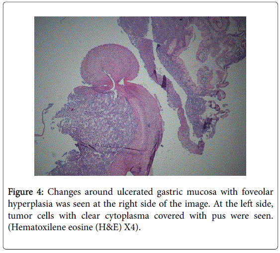 gastrointestinal-digestive-system-ulcerated-gastric