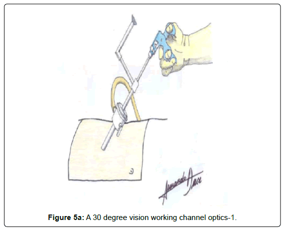 gastrointestinal-digestive-vision-working-channel