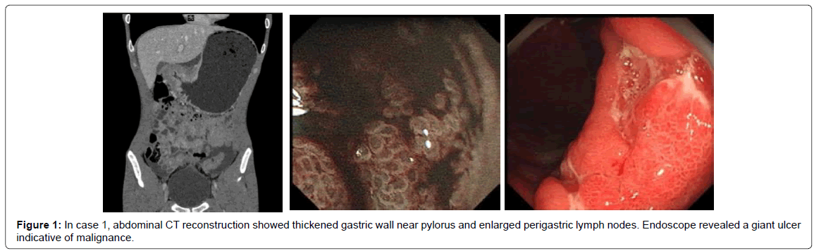 gastrointestinal-digestive-wall-near-pylorus