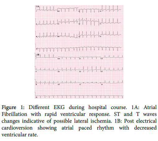 atrial fibrillation with rapid ventricular response icd 10