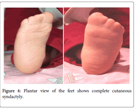 genetic-syndromes-gene-therapy-cutaneous-syndactyly