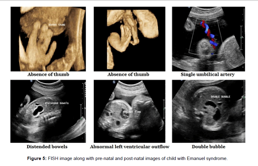 genetic-syndromes-gene-therapy-post-natal