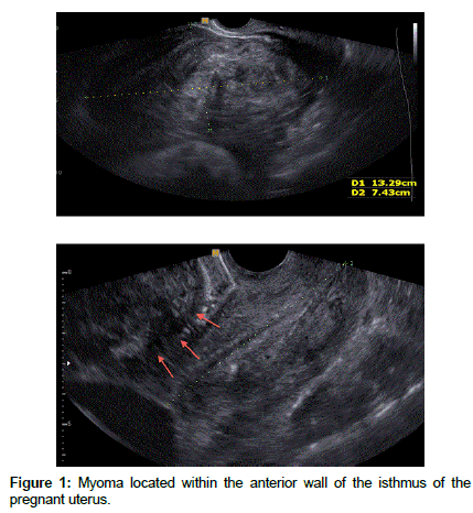 gynecology-obstetrics-Myoma-located-anterior