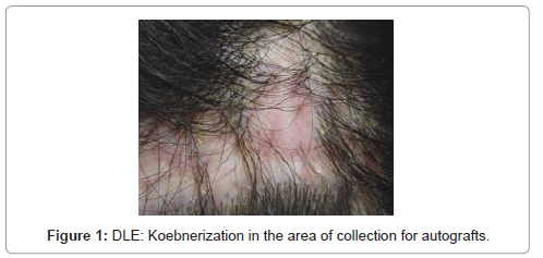 Inflammatory Alopecia: A Hidden Cause of an Announced Surgical Failure ...