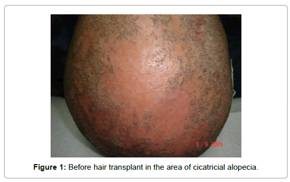 Hair Transplantation in the Cicatricial Alopecias | OMICS International