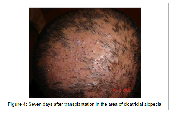 Hair Transplantation in the Cicatricial Alopecias | OMICS International