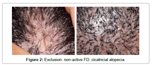 Related hair loss female azithromycin