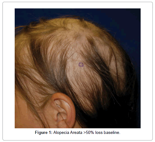 hair-therapy-transplantation-loss-baseline