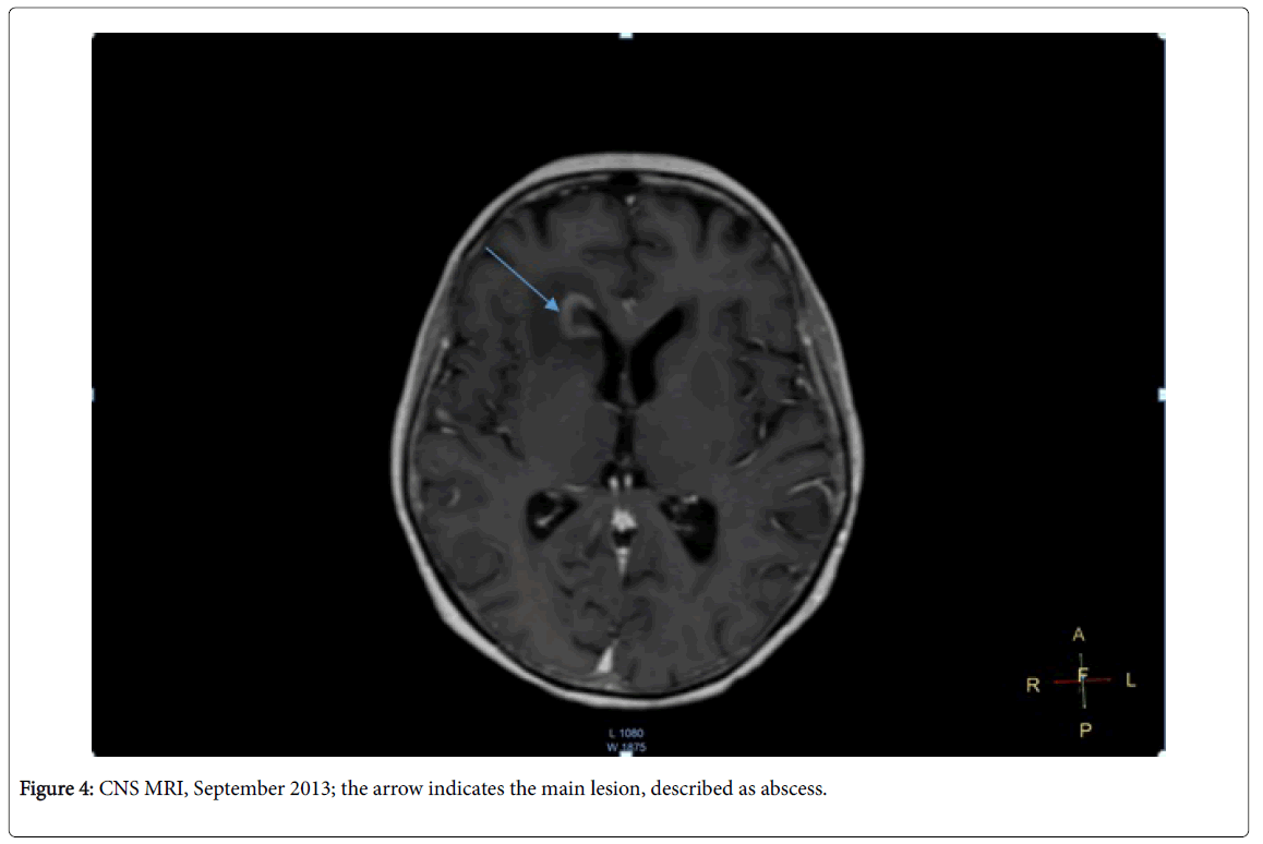 infectious-diseases-and-therapy-cns-mri