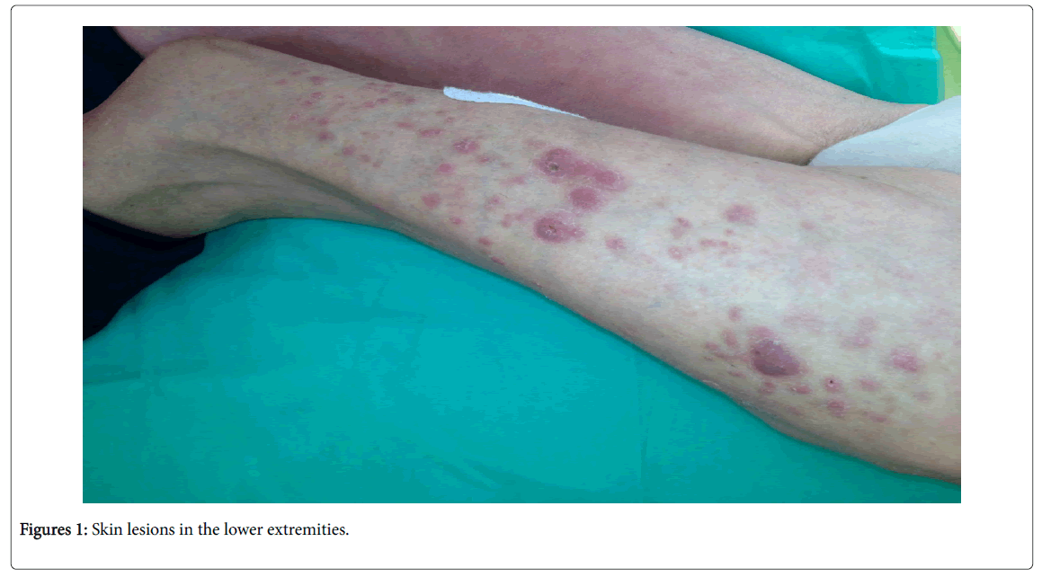 A Case Of Rare Cutaneous Mycobacteriosis And Central Nervous - 