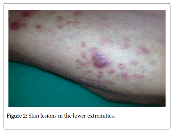 infectious-diseases-and-therapy-skin-lesions-lower-extremities