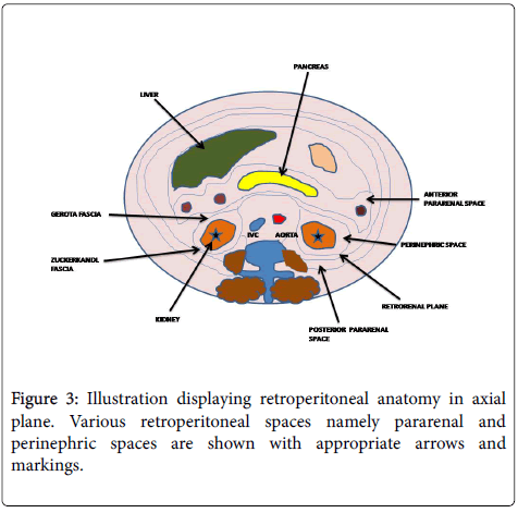 â Barriers Breachedâ : Pancreaticorenal Fistula Complicating Acute ...