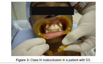 interdisciplinary-medicine-Class-malocclusion-patient