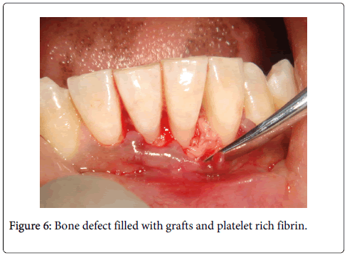 interdisciplinary-medicine-dental-science-Bone-defect-filled