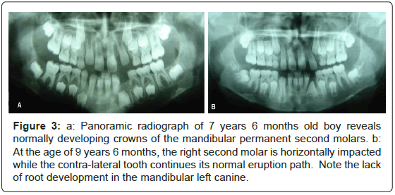 interdisciplinary-medicine-dental-science-Panoramic-radiograph-mandibular-permanent