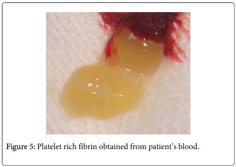 interdisciplinary-medicine-dental-science-Platelet-rich-fibrin