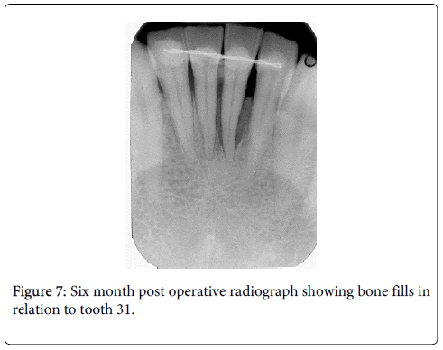 interdisciplinary-medicine-dental-science-Six-month-post-operative