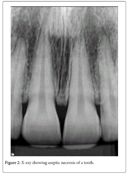 interdisciplinary-medicine-dental-science-X-ray-showing-aseptic